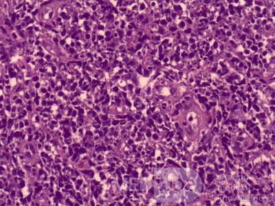 Non-Hodking Lymphoma B Cells. MALT (mucosa associated lymphoid tissue) (3 of 7)
