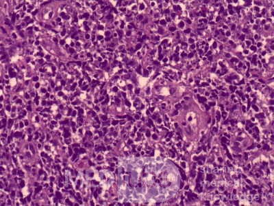 Non-Hodking Lymphoma B Cells. MALT (mucosa associated lymphoid tissue) (3 of 7)