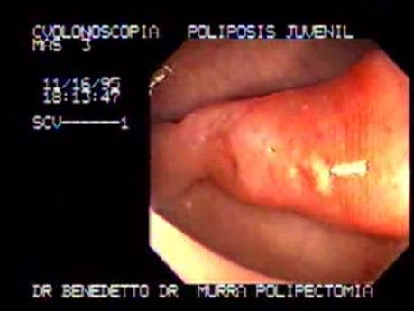 Non Familial Juvenile Polyposis Of The Colon (7 of 37)