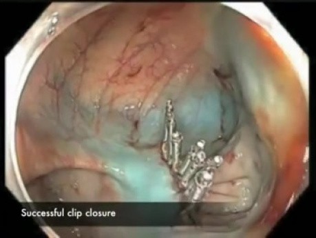 Cecum-EMR Bleed-Position Change-F