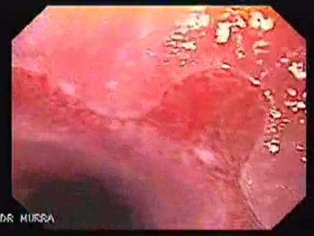 Barrett Esophagus (5 of 6)