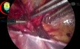Inverted Fundus Denoting Completion of the Dissection of the Sac