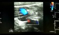 Carotid Artery Dissection