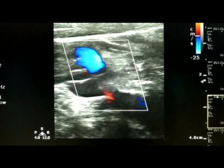 Carotid Artery Dissection