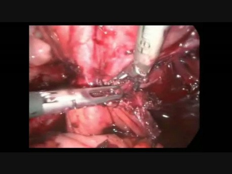 Laparoscopic Managment of Kissing Ovaries