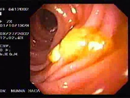 Gastric Adenocarcinoma With Signet Ring Cells - Endoscopy (2 of 4)