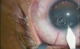 Bilateral Simultanous Cataract Extraction