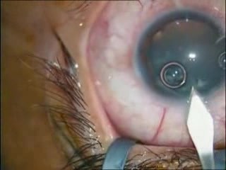 Bilateral Simultanous Cataract Extraction