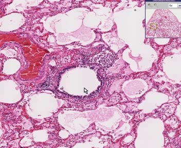 Early Pneumonia