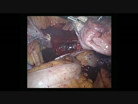 Simple Hysterectomy with Adnexectomy in Patient with BRCA Mutation