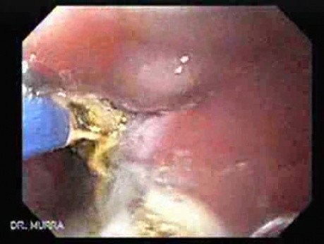 Endoscopic Ablation Of Barrett's Esophagus - 5/6