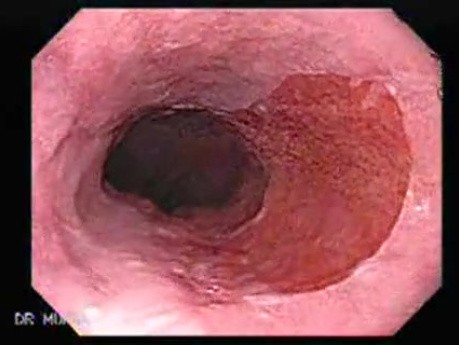 Gastric Heterotopia (inlet pach) (1 of 4)