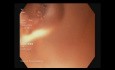 Uretero-Ileostomy