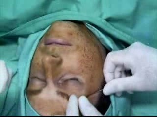 One Side Brow Lift