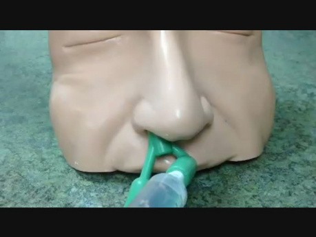 Posterior Epistaxis Treatment