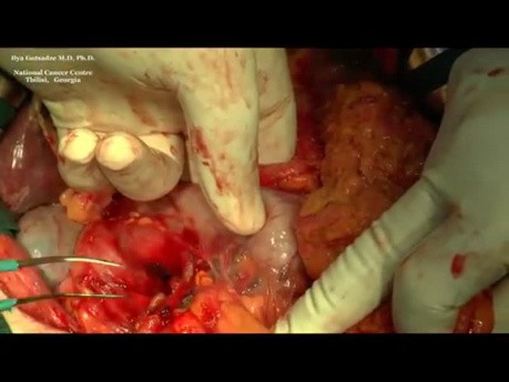 Radical Spleen Preserving Gastrectomy with D2 Lymphadenectomy