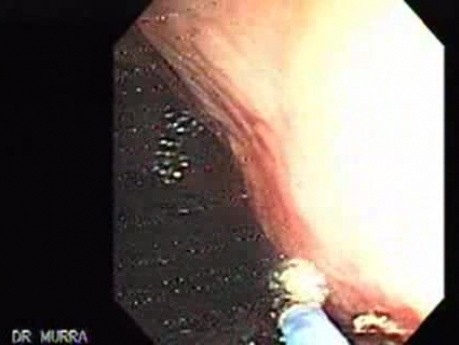 Gastric Cancer - Assessment of the Bleeding, Part 1