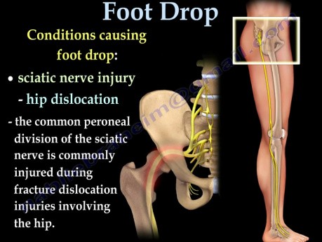 peroneal nerve foot drop