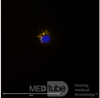 Circulating Tumor Cells (CTC) 
