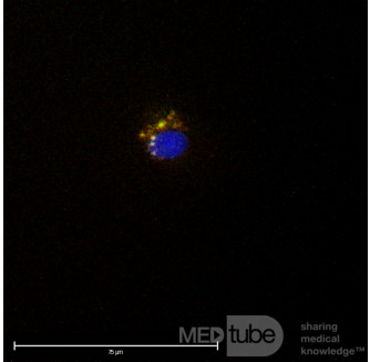 Circulating Tumor Cells (CTC) 