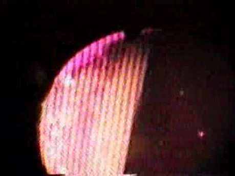 Foreign body of the stomach that resemble a snake (1 of 3)