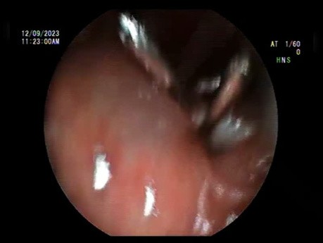 Perforation Closure - The Art of Clipping 