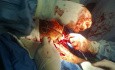 Soft Tissue Sarcoma of Left Axilla