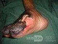 Neglected ischemic diabetic foot2