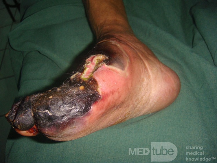 Neglected ischemic diabetic foot2
