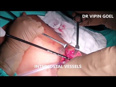 Bone (Rib) Sarcoma Excision: Excision of Segment of Chest Wall
