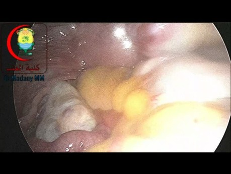 Diagnostic Lap in Chronic Recurrent Abdominal Pain
