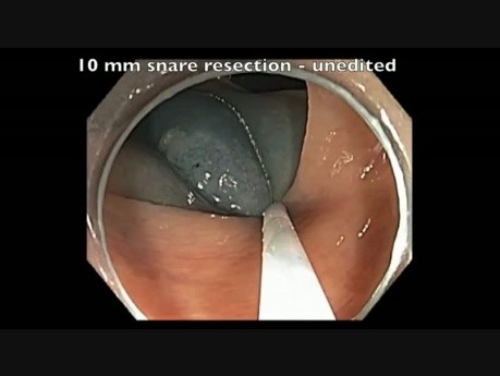 Subtle Flat Lesion EMR Resection