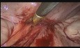 Laproscopic Removal of Prolene Mesh 