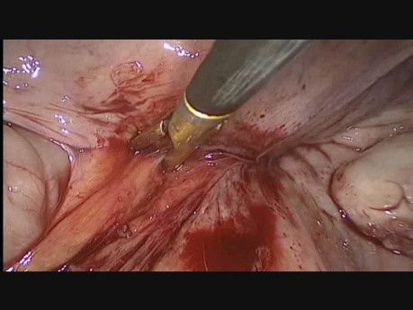 Laproscopic Removal of Prolene Mesh 