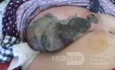 Infective Gangrene of a Female Breast