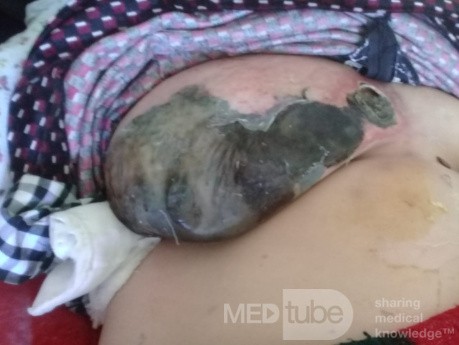 Infective Gangrene of a Female Breast
