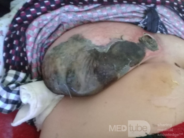 Infective Gangrene of a Female Breast
