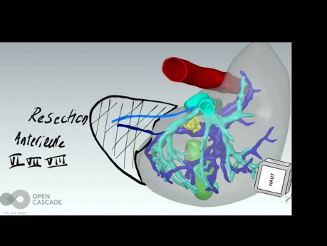 Three-Dimensional Reconstruction in the Planning of a Complex Liver Surgery