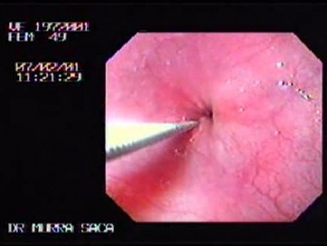 Esophageal Achalasia - Biopsy of Mucosa