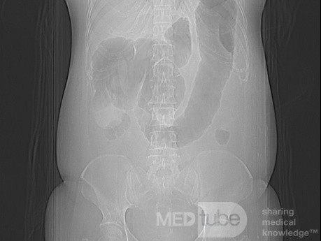 Multiple Rectal Ulcers (33 of 110)