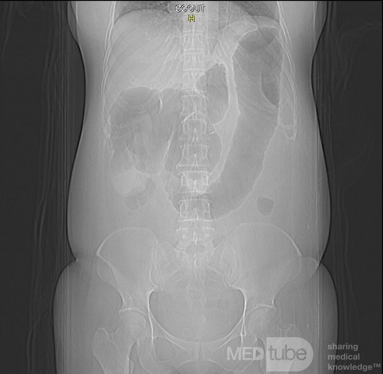 Multiple Rectal Ulcers (33 of 110)