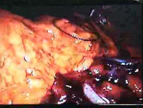 Jejunal Gastrointestinal Stromal tumor (GIST) (68 of 86)