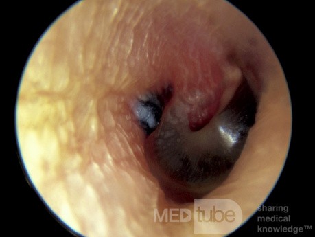 Herpes Zoster Tympanic Membrane