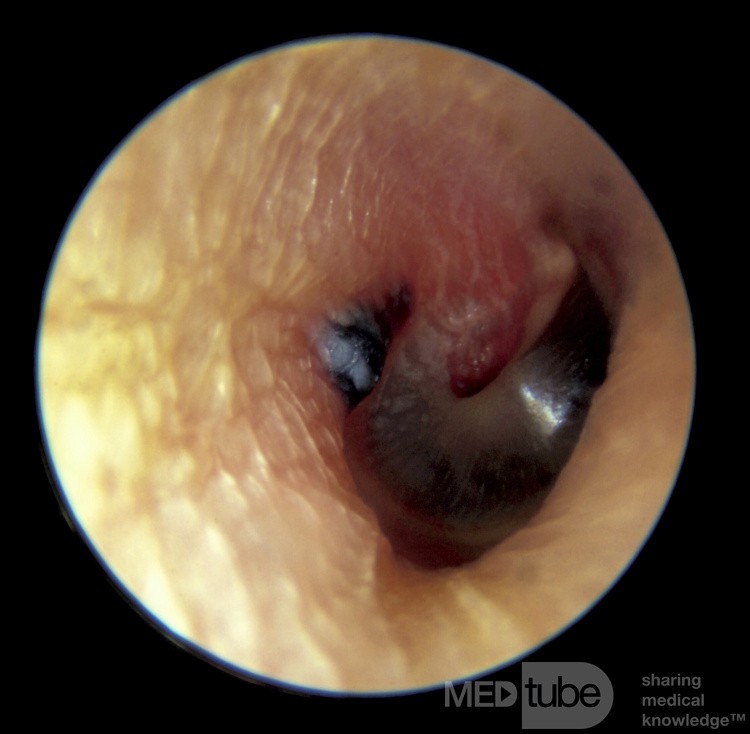 Herpes Zoster Tympanic Membrane