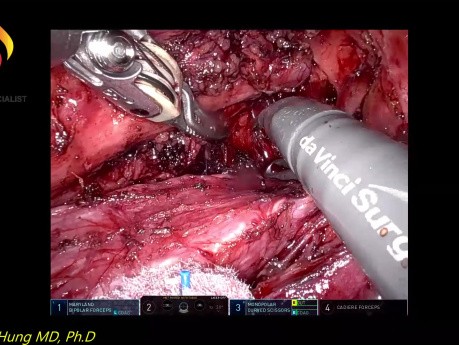 Robotic Left RCN Dissection