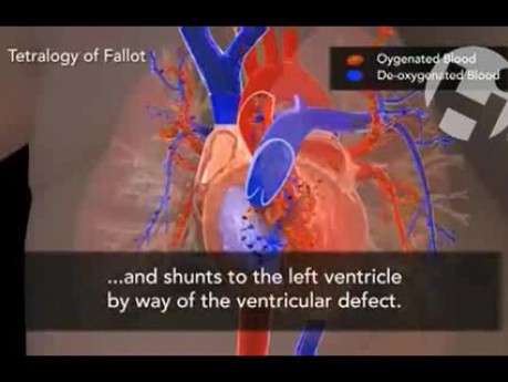 Tetralogy of Fallot Defects