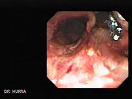Traqueostomy Fistula (2 of 5)