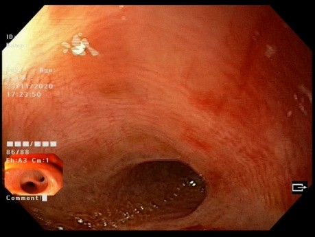 Use of Upper Endoscopy to Check Biliary System