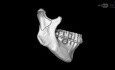 How About an Additional Place for Plate in Mandibular Condyle Osteosynthesis - Podcast