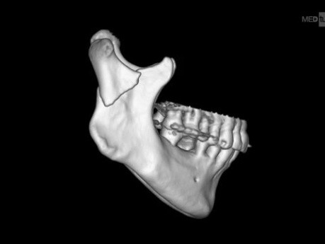 How About an Additional Place for Plate in Mandibular Condyle Osteosynthesis - Podcast